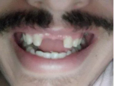 Implante dentários 2 dentes