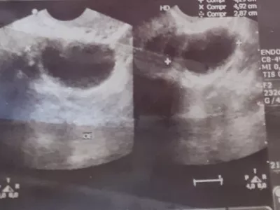 Tratamento médico - cirurgia de histerectomia
